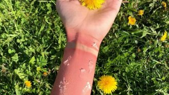 Буде тільки гірше: медики попередили про небезпеку використання Пантенола при сонячних опіках