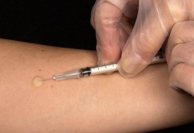 Манту, вакцинация, фото из свободных источников