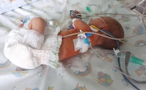Малыш весом 1 кг 300 грамм мужественно перенес операцию на сердце  (фото Институт сердца МОЗ Украины
