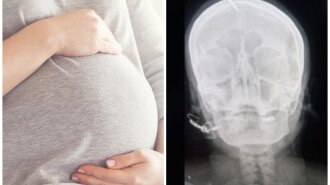 Беременная женщина вбила в голову гвоздь, чтобы родить мальчика: последовала совету "целителя"