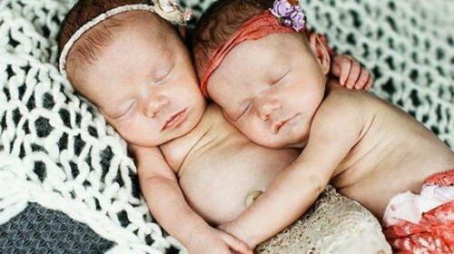 Родились, держась за руки: трогательная история сестер-близняшек (ФОТО)