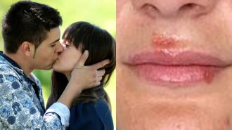 Болезни, которые передаются через поцелуи