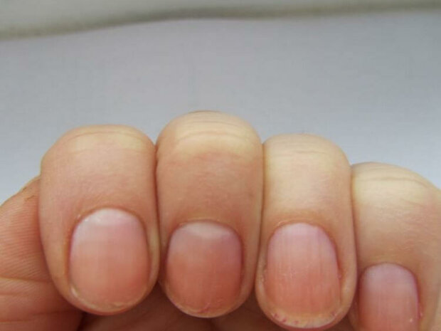 О каких болезнях "кричат" проблемы с ногтями: не пропусти опасный симптом