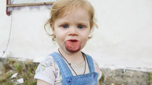 Двухлетняя украинка не может нормально жить из-за непропорционально большого языка: не помещается во рту