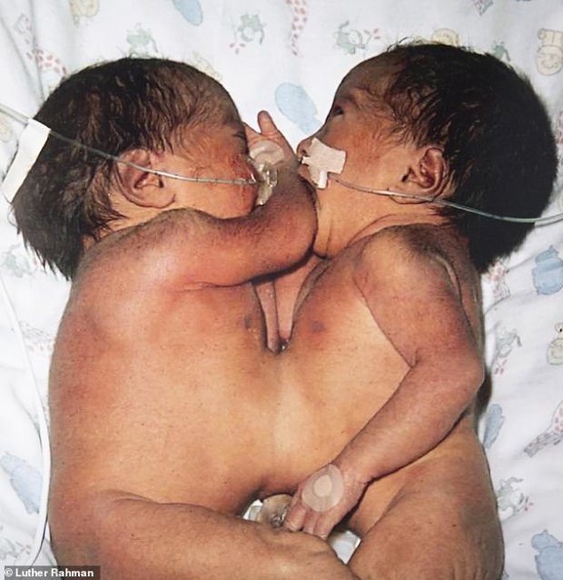 Сіамські близнюки Джаннет і Зейнаб народилися такими