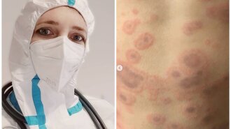 Педіатр з Дніпра показала моторошні шкірні прояви коронавірусу у дітей: "Реальні пацієнти " (ФОТО)