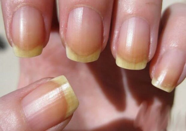 О каких болезнях "кричат" проблемы с ногтями: не пропусти опасный симптом