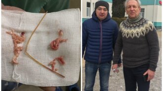 Слили кровь и охладили тело до 18°: львовские врачи провели уникальную операцию мужчине, который 25 лет жил с трубкой в сердце
