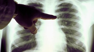 Як розпізнати рак легень: лікарі назвали "тривожні дзвіночки" організму