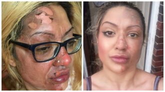 Женщина сильно обожгла лицо из-за лайфхака из соцсети: как она выглядит сейчас (ФОТО)