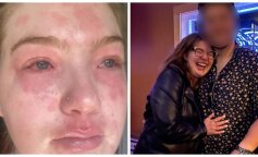 У девушки аллергия на ее парня: тело покрывается сыпью и слезятся глаза - врачи разводят руками (ФОТО)