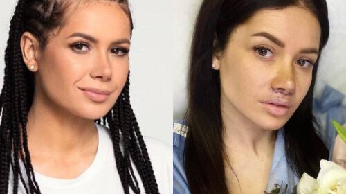 Жена звезды "Квартал 95"  показала лицо после пластики: фото до и после