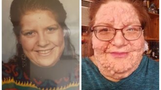 У женщины на лице выросли сотни опухолей: что с ней произошло (ФОТО)