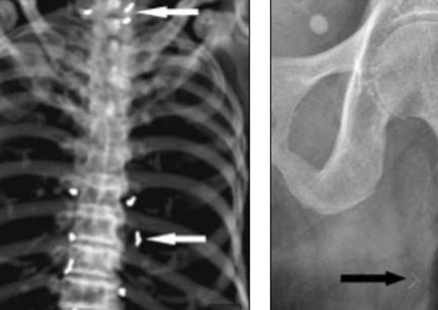 На этих рентгеновских снимках можно разглядеть частицы иголок, использовавшихся при процедуре акупун