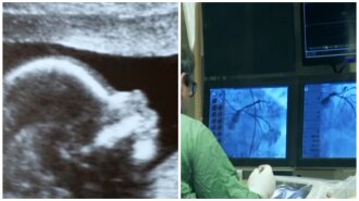 Медична аномалія: в Ізраїлі народилася дівчинка з близнюком у шлунку (ФОТО, ВІДЕО)