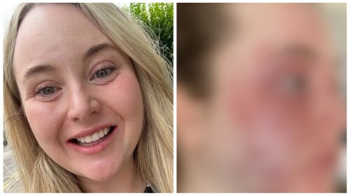 Набряки та "слоняча" шкіра: дівчина приголомшила алергічною реакцією на вініри