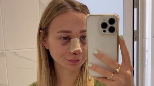 Перекроившая нос жена Павлика озвучила сумму, которую потратила на операцию