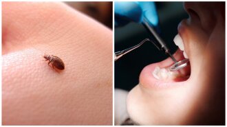 "Тут якась чорна лапка": під пломбою пацієнтки стоматолог виявив кліща — як це сталося