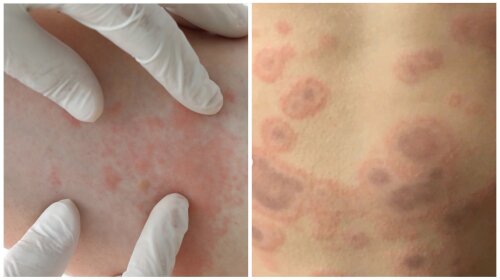 Медики назвали ТОП-6 шкірних проявів коронавірусу: "Може з'явитися в будь-який час"