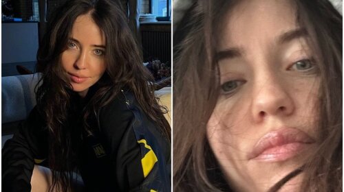 Помятая и опухшая: 33-летняя Дорофеева показала, каким стало ее лицо -  не узнать