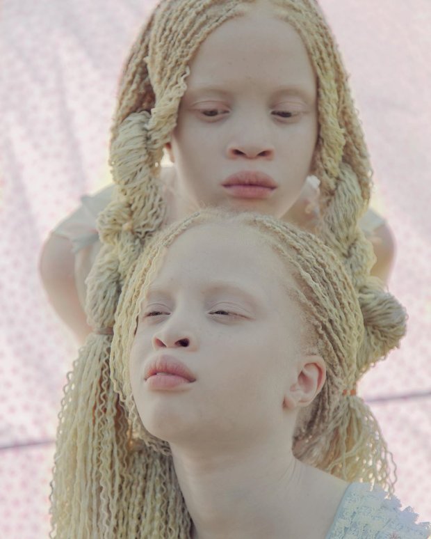 близнецы-альбиносы