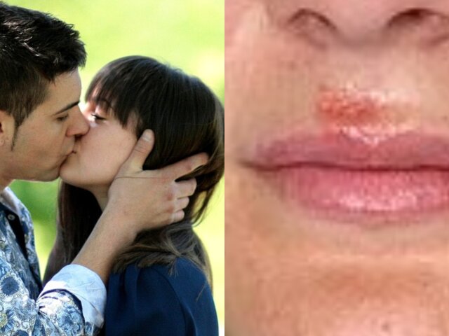 Хвороби, які передаються через поцілунки